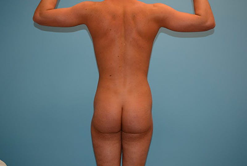 Liposuction Before & After Gallery - Patient 120905677 - Image 8