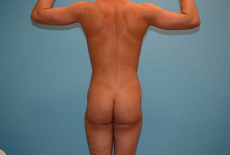 Liposuction Gallery - Patient 120905677 - Image 8