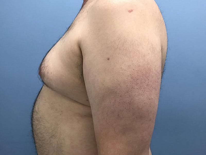 Gynecomastia Before & After Gallery - Patient 120905678 - Image 5