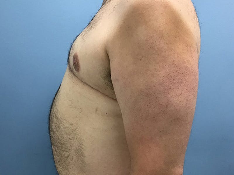 Gynecomastia Before & After Gallery - Patient 120905678 - Image 6