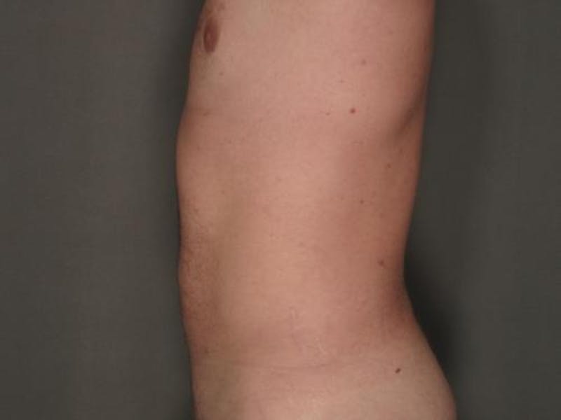 Liposuction Gallery - Patient 120905679 - Image 2