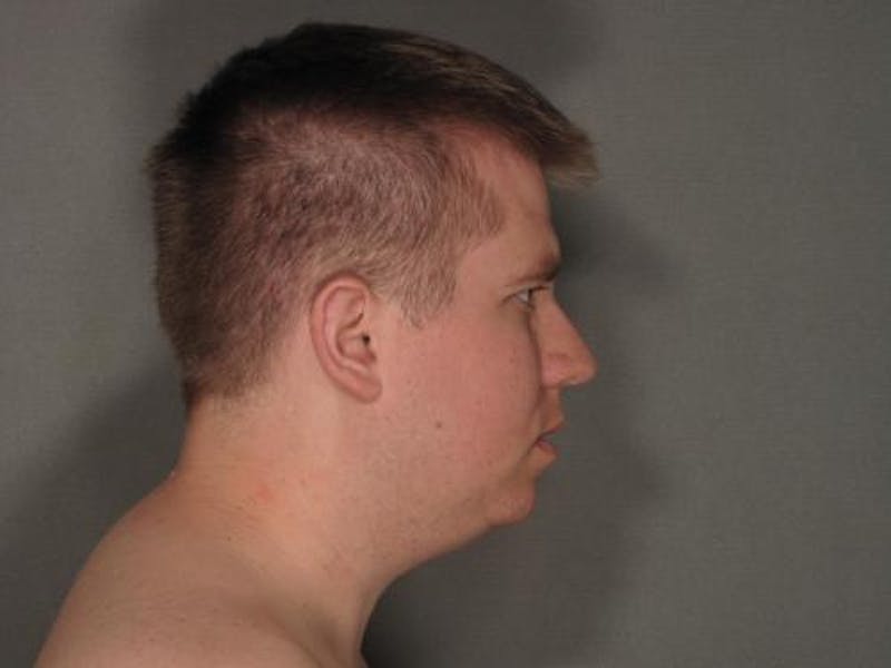 Liposuction Before & After Gallery - Patient 120905679 - Image 7