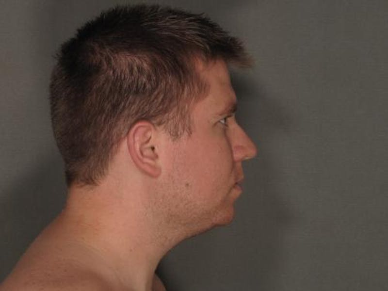 Liposuction Before & After Gallery - Patient 120905679 - Image 8