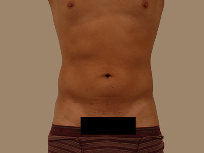 Liposuction Before & After Gallery - Patient 120905680 - Image 1