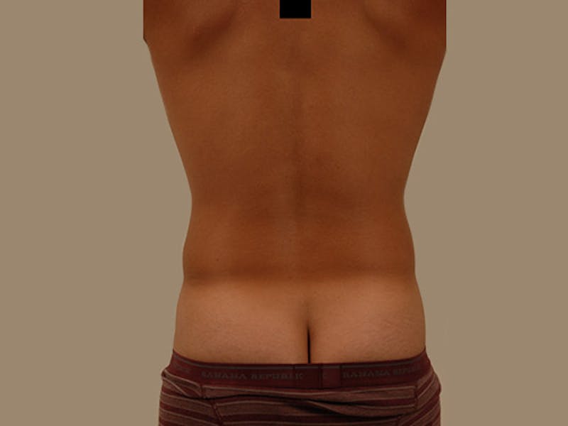 Liposuction Before & After Gallery - Patient 120905680 - Image 7