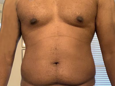 Liposuction Before & After Gallery - Patient 120905684 - Image 1