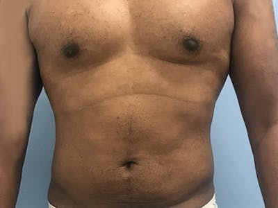 Liposuction Before & After Gallery - Patient 120905684 - Image 2