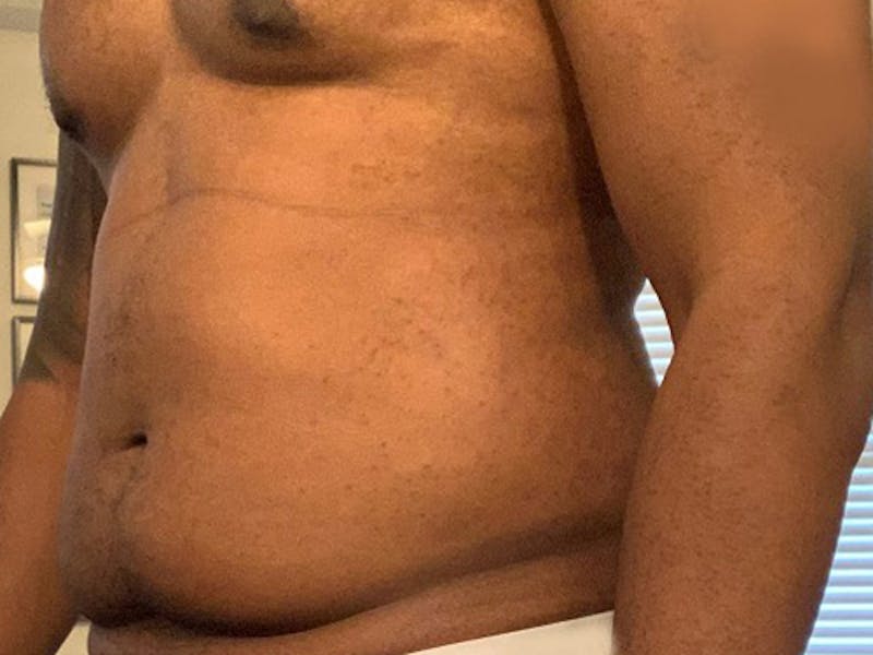 Liposuction Before & After Gallery - Patient 120905684 - Image 3