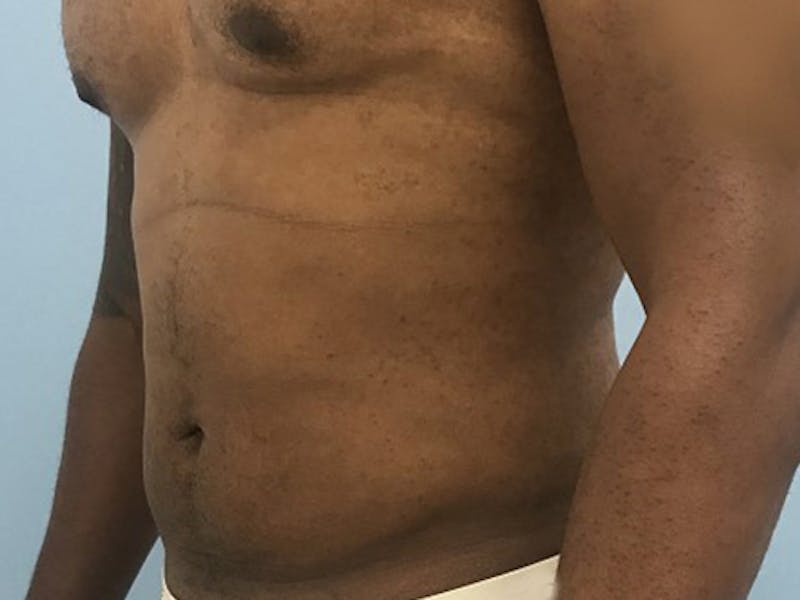 Liposuction Before & After Gallery - Patient 120905684 - Image 4