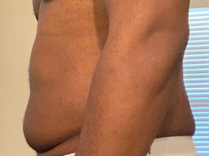 Liposuction Before & After Gallery - Patient 120905684 - Image 5