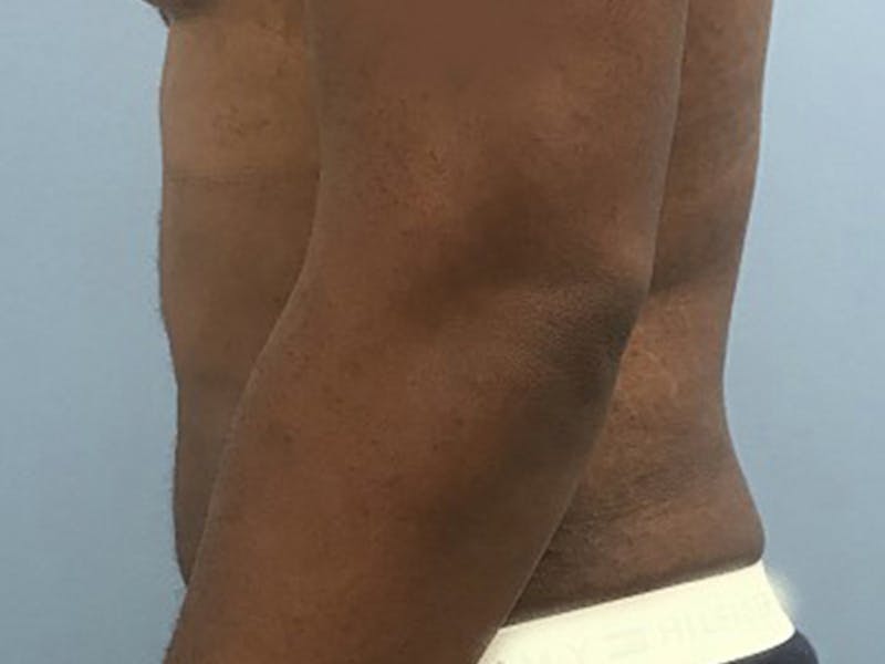 Liposuction Before & After Gallery - Patient 120905684 - Image 6