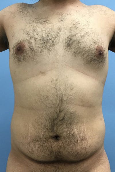 Liposuction Before & After Gallery - Patient 120905688 - Image 1