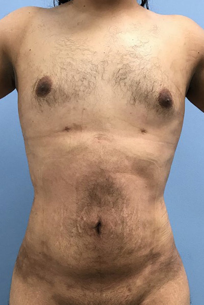 Liposuction Before & After Gallery - Patient 120905688 - Image 2