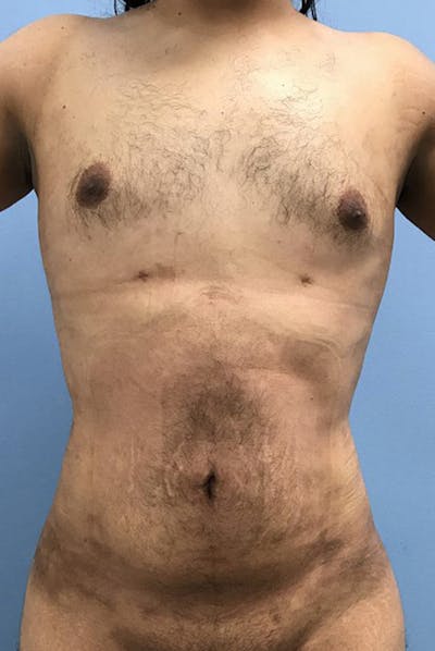 Liposuction Before & After Gallery - Patient 120905688 - Image 2