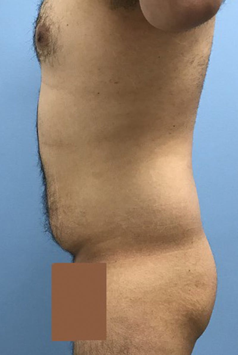 Liposuction Before & After Gallery - Patient 120905688 - Image 3