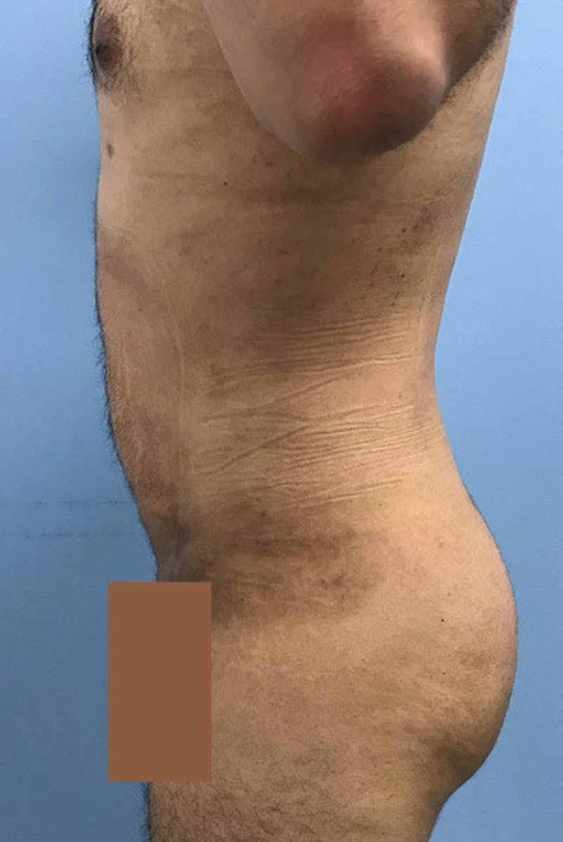 Liposuction Before & After Gallery - Patient 120905688 - Image 4