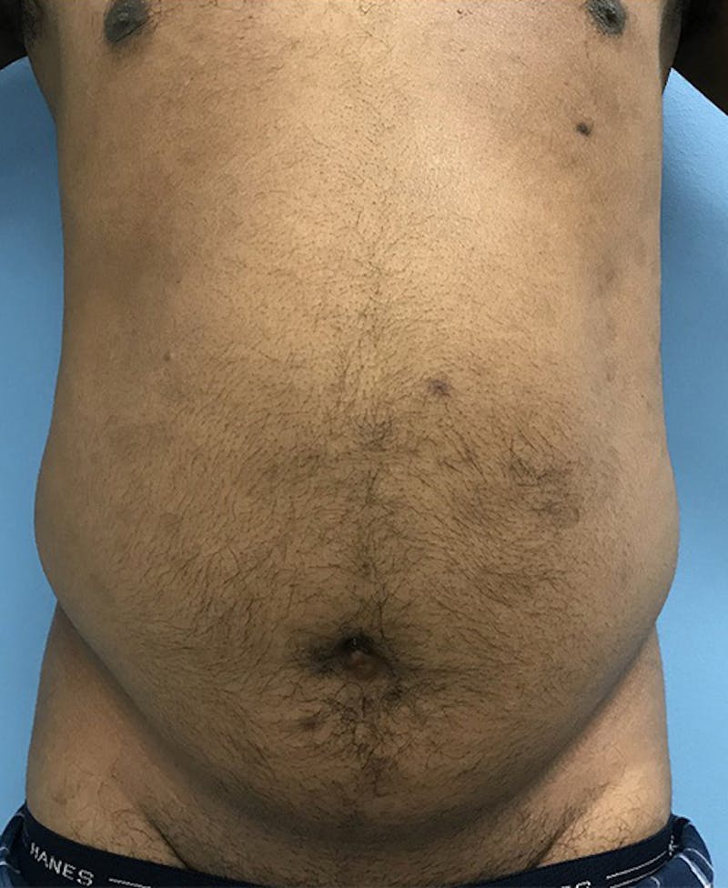 Liposuction Before & After Gallery - Patient 120905689 - Image 1