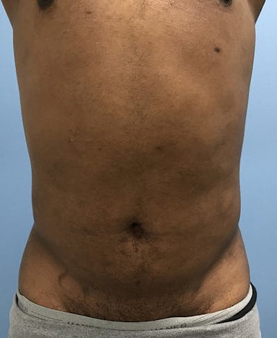 Liposuction Gallery - Patient 120905689 - Image 2