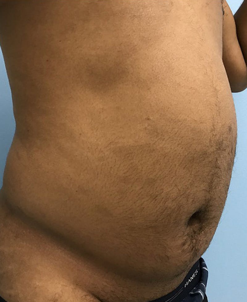 Liposuction Gallery - Patient 120905689 - Image 3