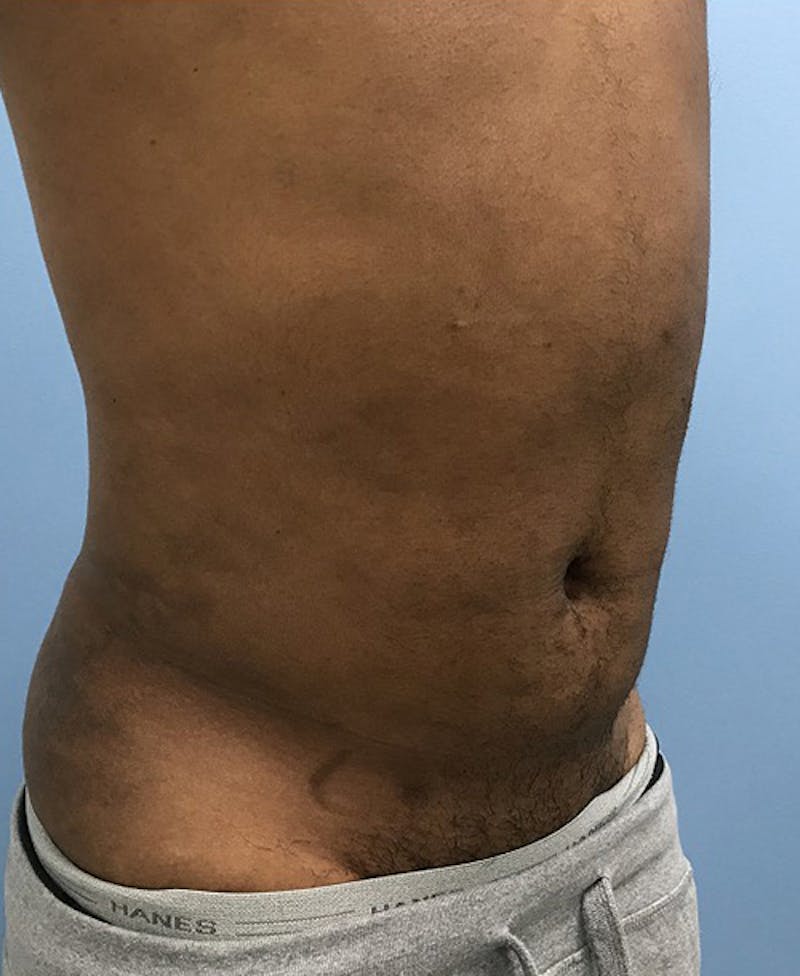 Liposuction Before & After Gallery - Patient 120905689 - Image 4