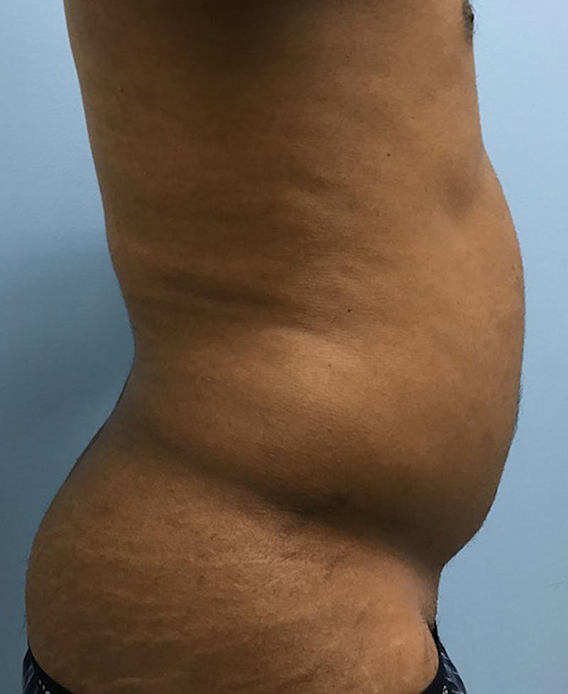 Liposuction Before & After Gallery - Patient 120905689 - Image 5