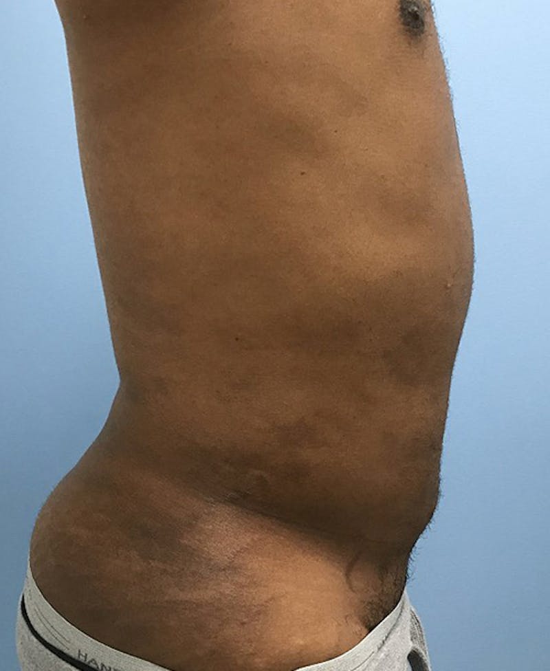 Liposuction Before & After Gallery - Patient 120905689 - Image 6