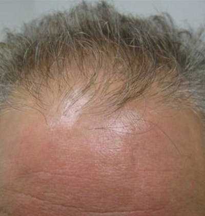 Hair Restoration Before & After Gallery - Patient 120905741 - Image 1