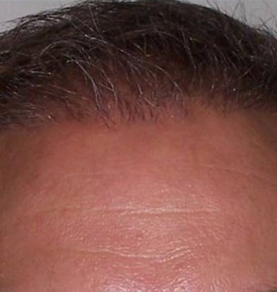Hair Restoration Before & After Gallery - Patient 120905741 - Image 2