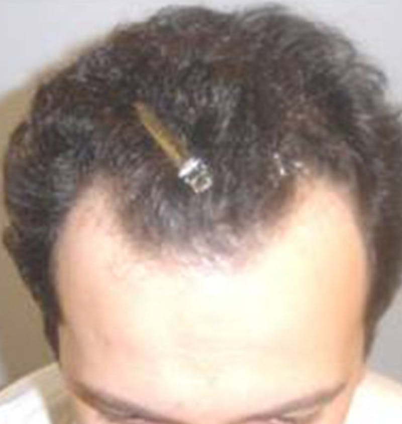 Hair Restoration Before & After Gallery - Patient 120905744 - Image 1