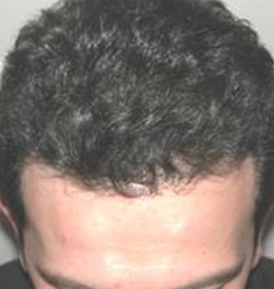 Hair Restoration Before & After Gallery - Patient 120905744 - Image 2