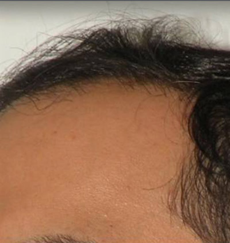 Hair Restoration Before & After Gallery - Patient 120905749 - Image 1
