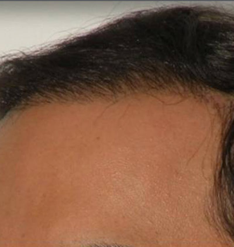Hair Restoration Before & After Gallery - Patient 120905749 - Image 2