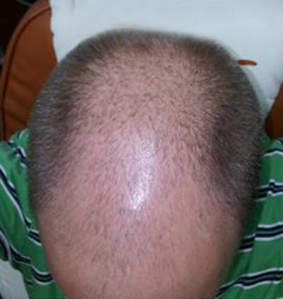 Hair Restoration Before & After Gallery - Patient 120905754 - Image 1