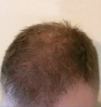 Hair Restoration Before & After Gallery - Patient 120905754 - Image 2