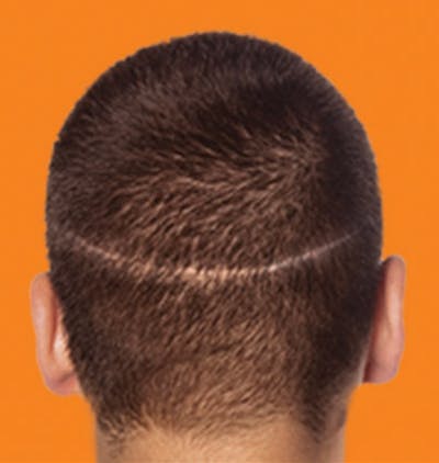 Hair Restoration Before & After Gallery - Patient 120905798 - Image 1