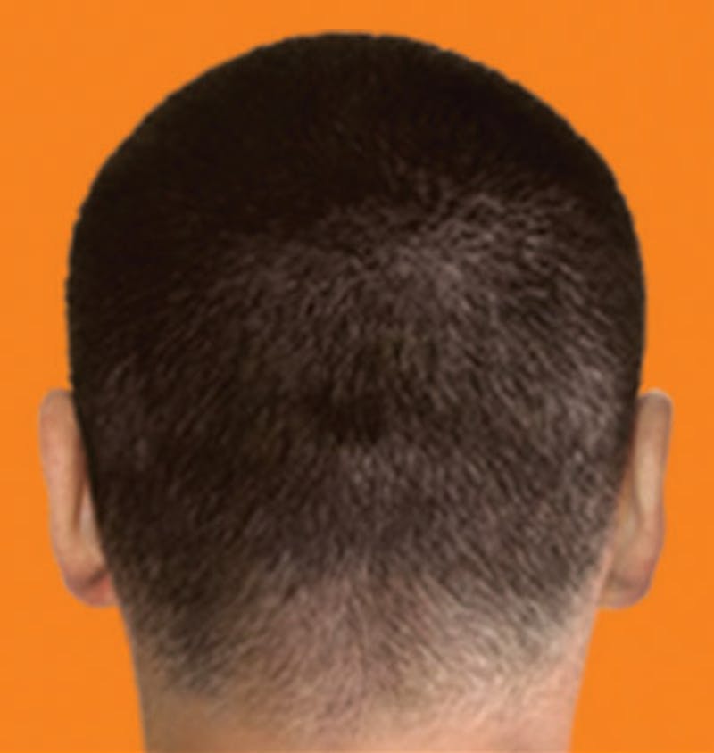 Hair Restoration Before & After Gallery - Patient 120905798 - Image 2