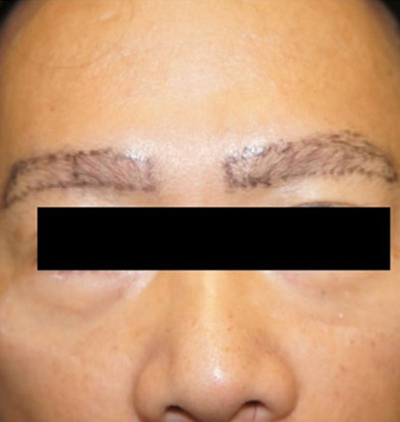 Hair Restoration Before & After Gallery - Patient 120905811 - Image 1