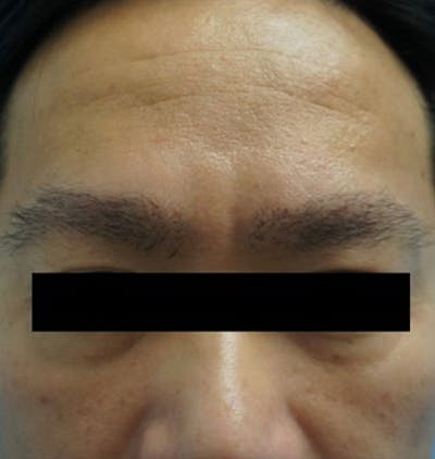 Hair Restoration Before & After Gallery - Patient 120905811 - Image 2
