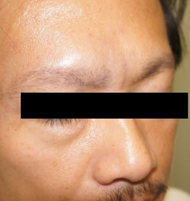 Hair Restoration Before & After Gallery - Patient 120905811 - Image 3