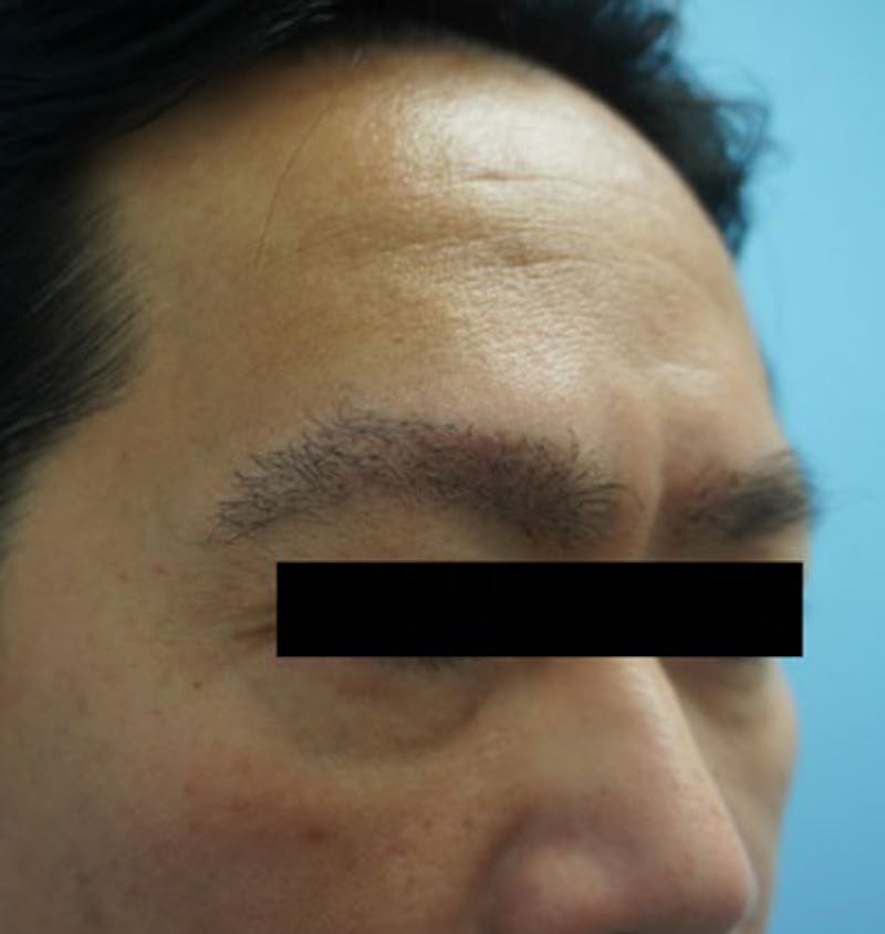 Hair Restoration Before & After Gallery - Patient 120905811 - Image 4