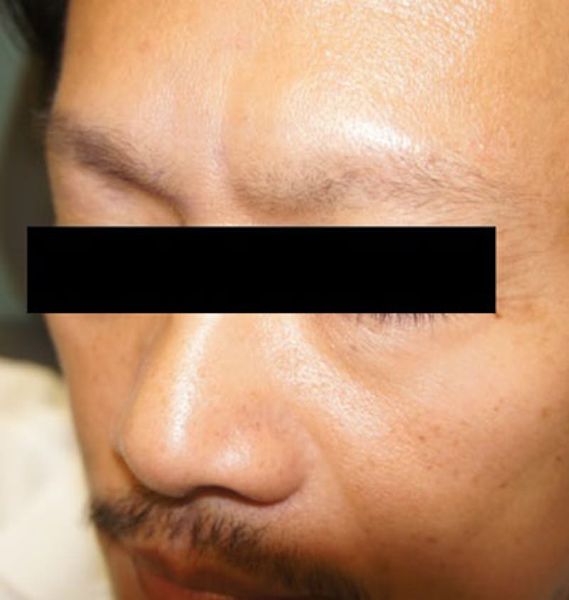 Hair Restoration Before & After Gallery - Patient 120905811 - Image 5