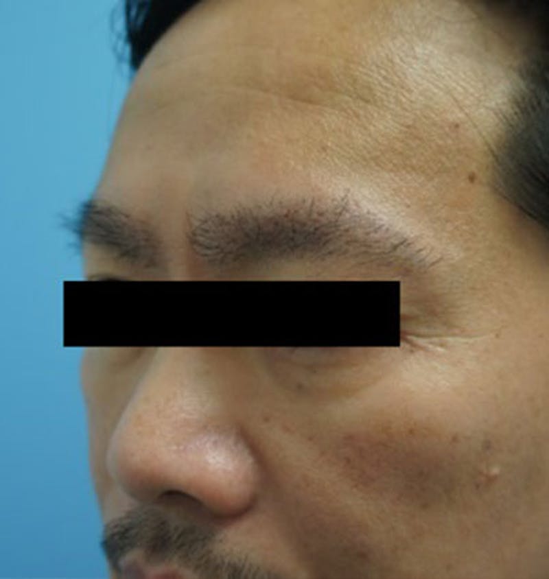 Hair Restoration Before & After Gallery - Patient 120905811 - Image 6