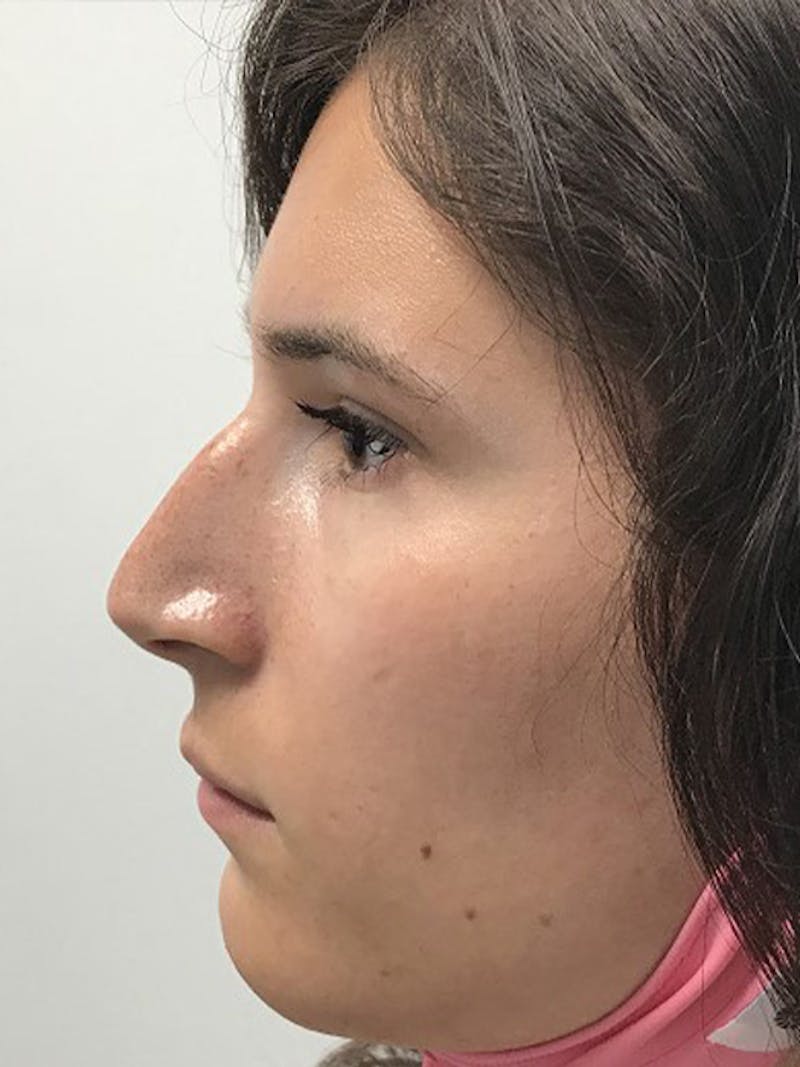 Injectables Before & After Gallery - Patient 120905812 - Image 3