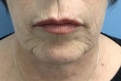 Injectables Before & After Gallery - Patient 120905815 - Image 1