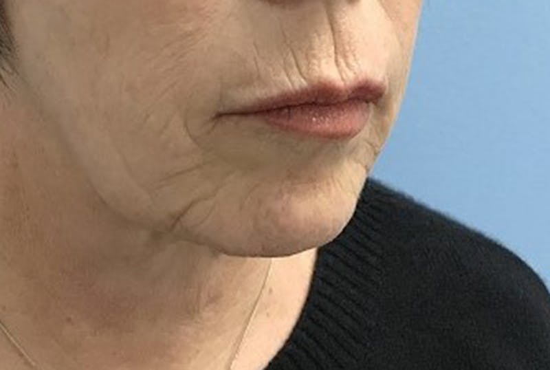Injectables Before & After Gallery - Patient 120905815 - Image 3