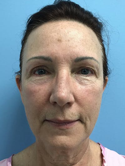 CO2 Laser Before & After Gallery - Patient 120905834 - Image 1
