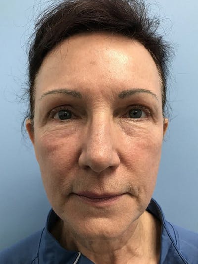 CO2 Laser Before & After Gallery - Patient 120905834 - Image 2