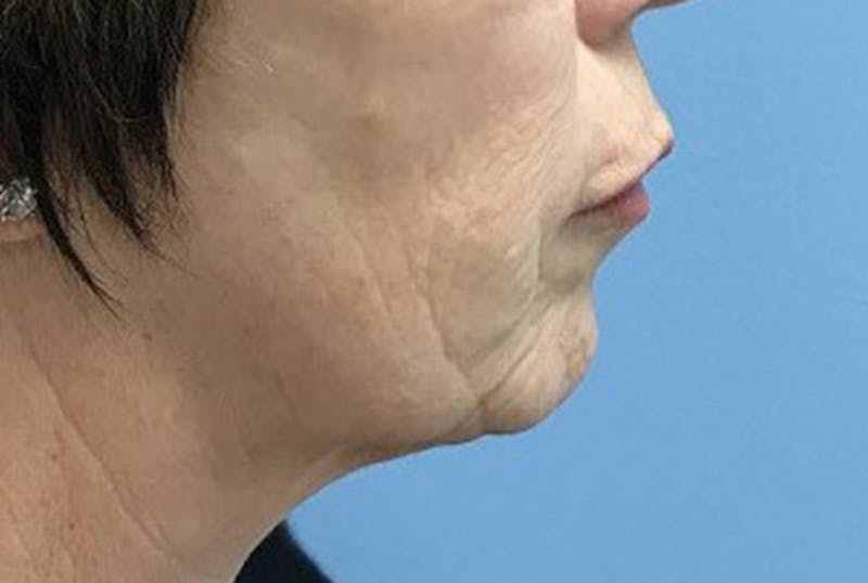 Injectables Before & After Gallery - Patient 120905815 - Image 5