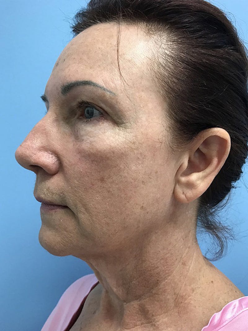 CO2 Laser Before & After Gallery - Patient 120905834 - Image 3