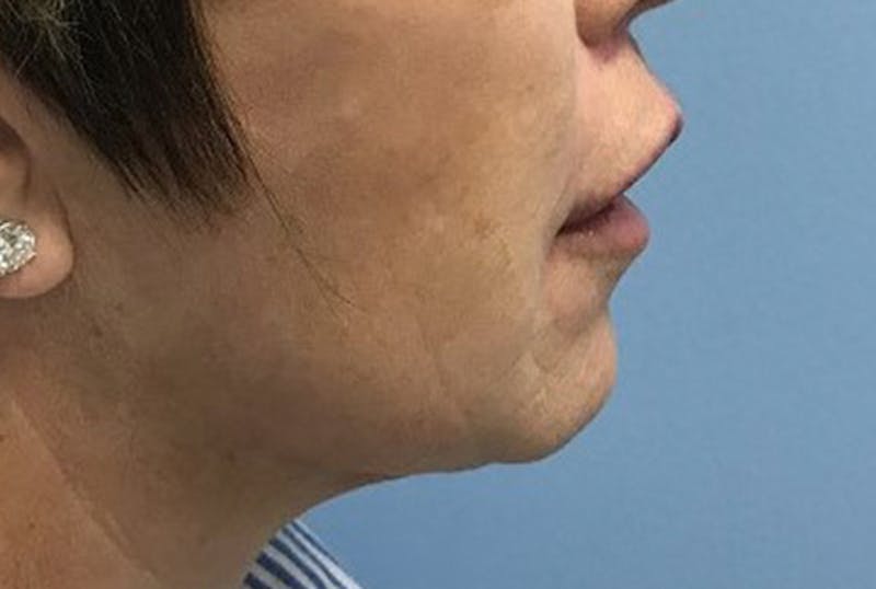 Injectables Before & After Gallery - Patient 120905815 - Image 6